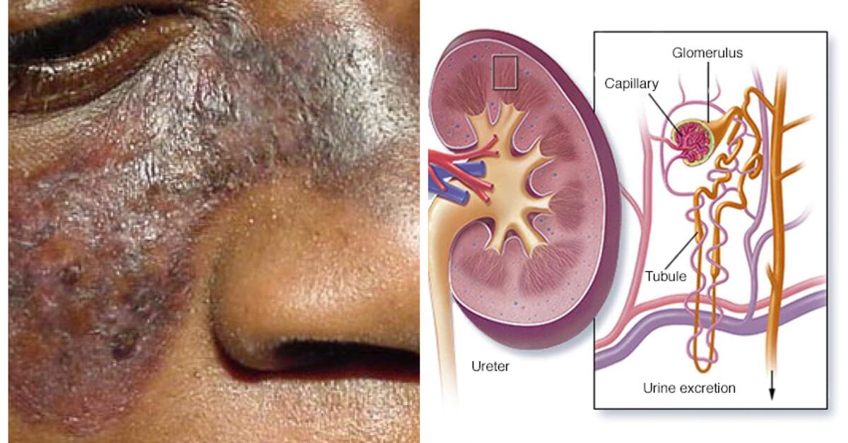 LUPUS FOUNDATION: "The Kidneys are The Most Commonly Affected Organ in