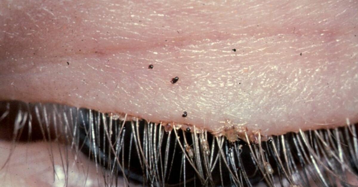 Alert Doctors Warn Women To Wash Eyelash Extensions To Avoid Lash Lice Rlsmedia Com